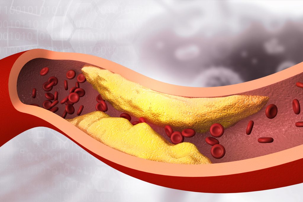 atherosclerosis plaque